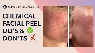 Are Chemical Peels Safe? Facial Peel Do's and Don'ts!