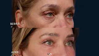 Eyelid Lift Surgery + CO2 Laser | Before and After | Dr. David Stoker