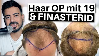 5 Wochen nach Haartransplantation & 9 Monate Finasterid | 4500 Grafts | Erfahrung