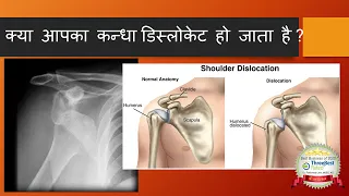 Shoulder Dislocation: Why, How , what to Do ? क्या आपका कन्धा उतर जाता है, ऐसा क्यों होता है ?