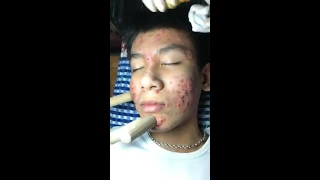 Cleansing acne for 16 year old boy living in Hòa Sơn  Part 1 ( official video )