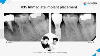 Dr. Yongseok CHO, Sewoung KIM, #35 Immediate implant surgery and prosthesis