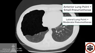 POCUS Cases 1: Pneumothorax