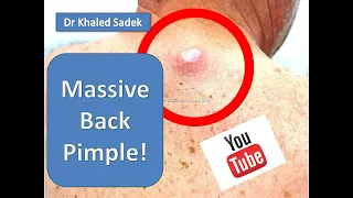 Large Sebaceous Cyst Removal. LipomaCyst.com Dr Khaled Sadek