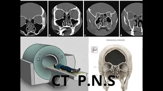 فحص الأشعة المقطعية على الجيوب الأنفية CT PNS