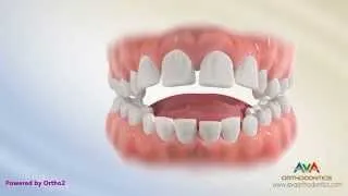 Orthodontic Treatment for Tongue Thrusting Habit - Different Options