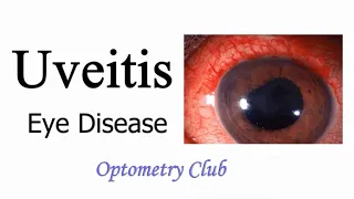 Uveitis Definition and classification || Ocular Disease || Optometry Club ||