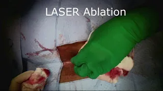 Pilonidal Sinus Laser Ablation (SiLac )