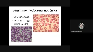 INTRODUÇÃO AS ANEMIAS NORMOCÍTICAS E NORMOCRÔMICA