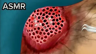 ASMR Remove Spider & Maggot Lips Infected | Severely Injured Animation/ASMR effect