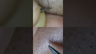 Extractions Ingrown Hair l Tweezers Beard l re-edit 2220+2217