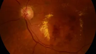 BRANCH RETINAL VEIN OCCLUSION & GLAUCOMA