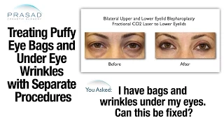 Puffy Eye Bags and Under Eye Wrinkles Can be Treated with Separate Procedures