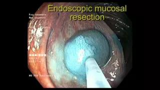 Screening colonoscopy. Acetic acid and indigocarmine for serrated colonic lesions