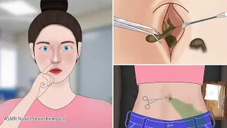 ASMR Remove Huge Navel Stone | Satisfying Percing Clean Animation