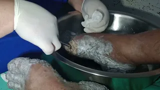 Retirada de miíase, berne, tapuru, larva. parasita. Infestação em ferida. Atendimento Hospitalar.