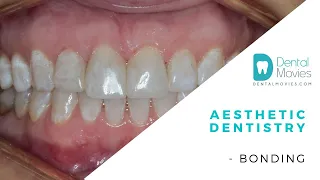 Aesthetic dentistry - bonding