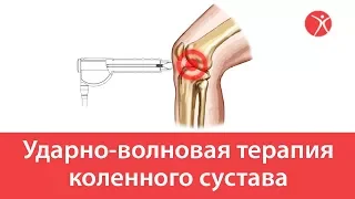 Ударно-волновая терапия коленного сустава в клинике Стопартроз