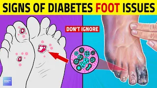 8 Alarming Signs of Diabetes Foot Complications!