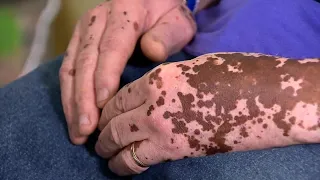 Breakthrough for Vitiligo