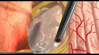 Animation - Spinal Cord Intramedullary Tumor.mov