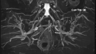 Normal MR Neurography Lumbosacral Plexus