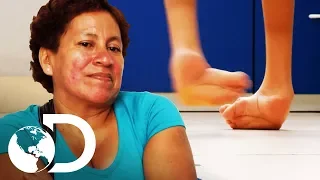 Cirurgia para endireitar os pés | Meu Corpo, Meu Desafio | Discovery Brasil