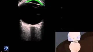 3D How To: Ocular Ultrasound - SonoSite Ultrasound