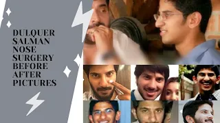 dulquer salmaan unseen pictures before and after plastic surgery (nose surgery)..dulquer's nose job.