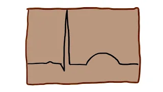 Po mojemu: EKG cz. 4