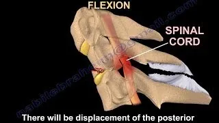 Tear Drop Fracture of the cervical spine - Everything You Need To Know - Dr. Nabil Ebraheim