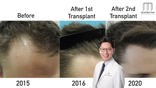 Hair Transplant Before and After | 5 Year Hairline Restoration | Dr Mark Tam