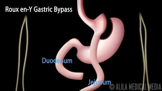Roux en-Y Gastric Bypass, with Introduction on Body Mass Index, Animation.