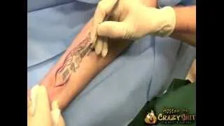 Удаление татуировки.(tattoo-removal)