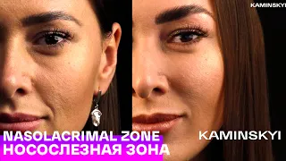 НОСОСЛЕЗНАЯ ЗОНА / NASOLABIAL ZONE ★ EDGAR KAMINSKYI