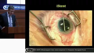 Malyugin. CURRENT TRENDS OF GLAUCOMA MICROSURGERY IN PATIENTS WITH CATARACT