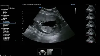 13 weeks pregnancy ultrasound