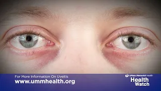 Health Watch: Uveitis Causes and Treatment