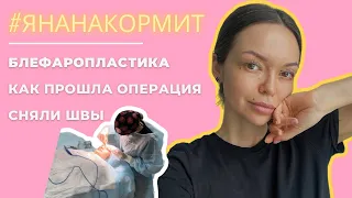 БЛЕФАРОПЛАСТИКА | КАК ПРОШЛА ОПЕРАЦИЯ | РЕАБИЛИТАЦИЯ