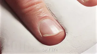 One Year Time Lapse of Growing-Trimming Fingernail