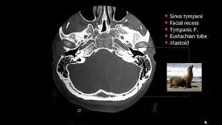 Imaging of Petrous bone I    Prof Dr  Mamdouh Mahfouz In Arabic