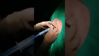 Epidural Catheter Insertion technique.