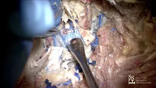 Far Lateral Craniotomy for PICA and Vertebral Basilar Junction - Aaron Dumont, MD, FACS, FAHA