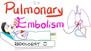 Pulmonary Embolism (PE)