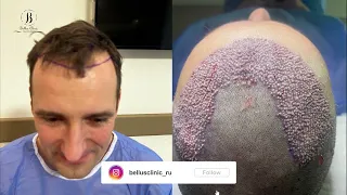 hair transplant, hairline and crown restoration