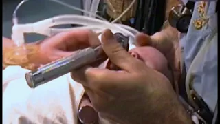 7-37.  Intubation of an Infant