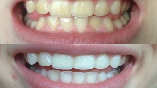 How I whitened my VERY yellow teeth! (WORKS!) BEFORE AND AFTER!