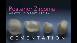 Zirconia Ceramics, Part 5: Posterior Onlay, 3/4, Vonlay and Crown Cementation