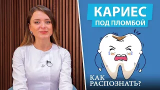 Кариес под пломбой: невидимое вторжение (вторичный кариес)