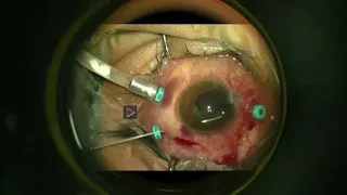 AIOC2021 - VT150 - Role of Vitrectomy in Endophthalmitis